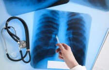 туберкулез, рентген, легкие, врач, медик, медицина